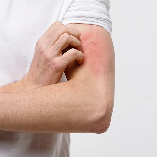 Allergie cutanée